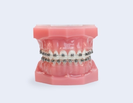 Adult & Pediatric Orthodontics - Metal Braces