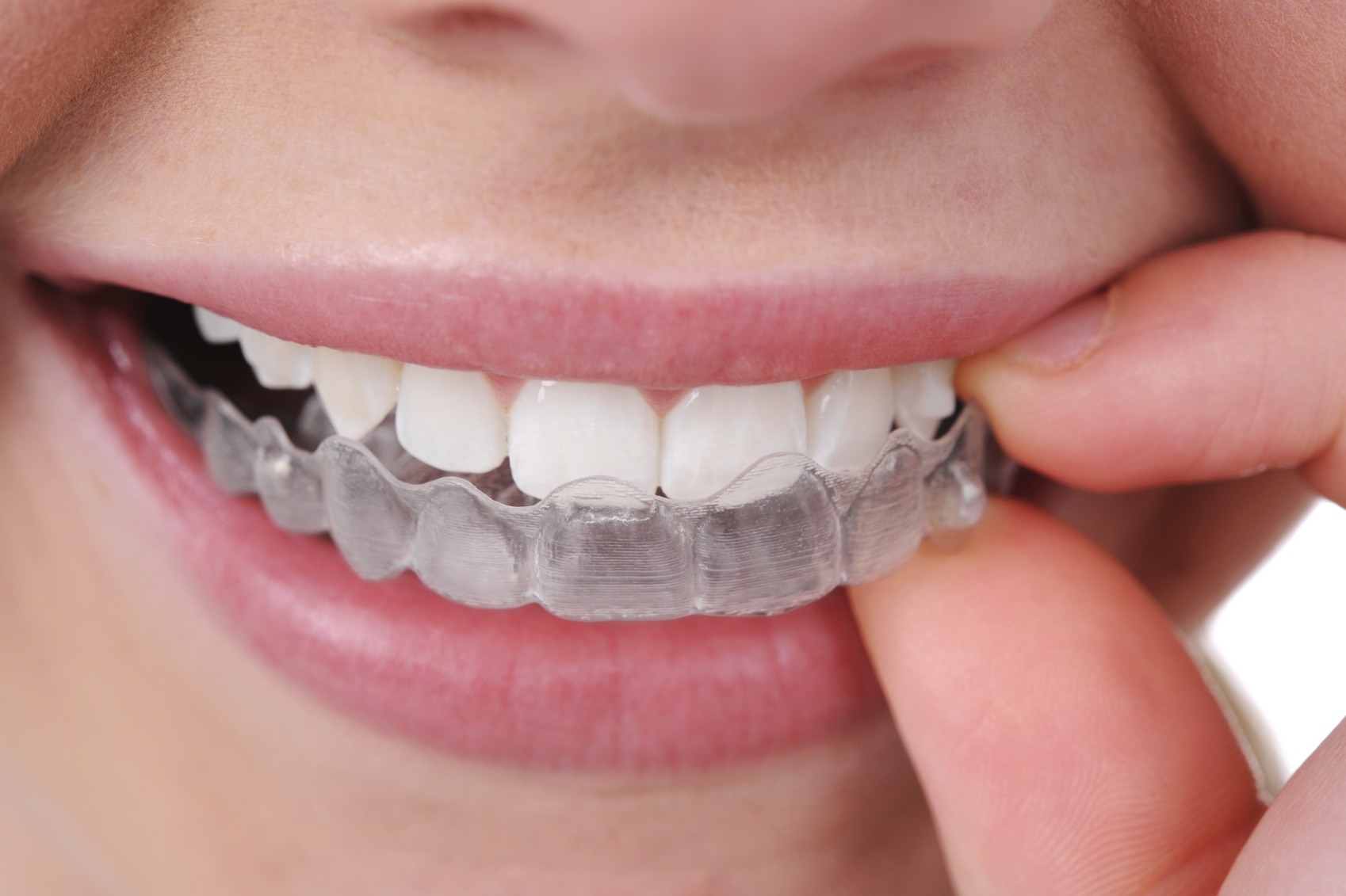 Staying Safe and Healthy with Clear Aligners During COVID-19