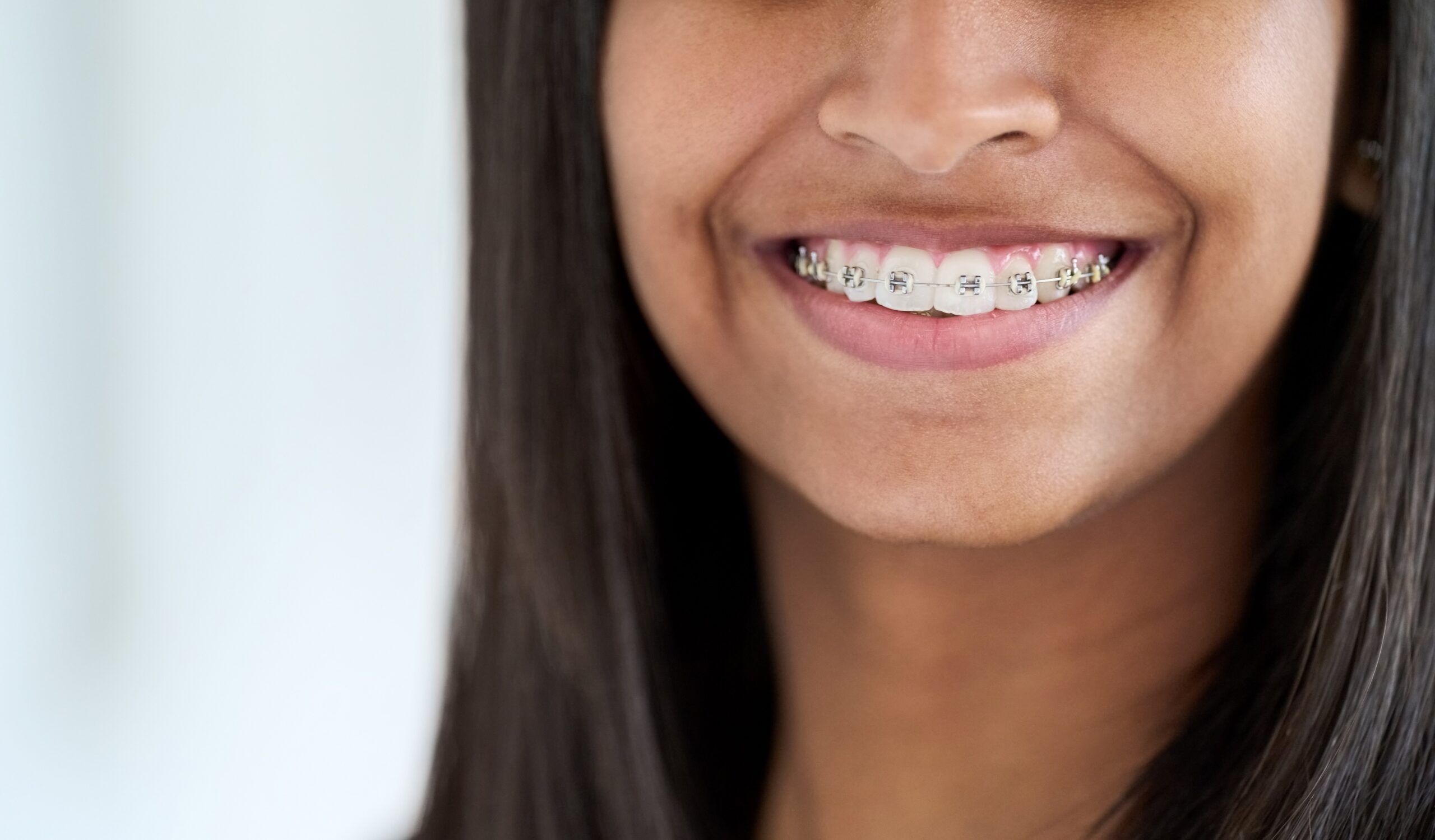 How Do Braces Move Teeth?