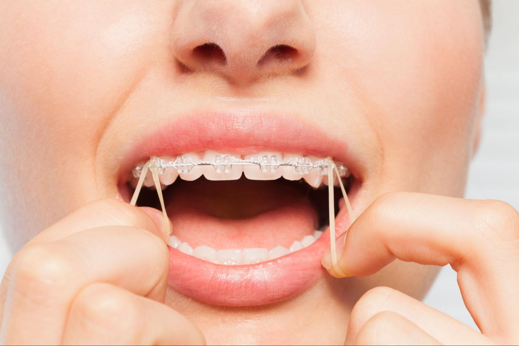 What Is the Purpose of Rubber Bands in Braces Treatment?