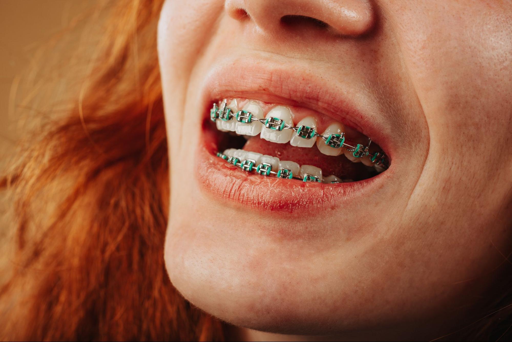What to Do When Braces Break?
